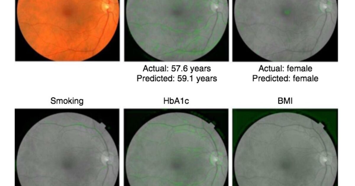 
    Google has developed an AI that detects the risks of heart disease by scanning the eyes
